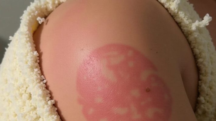 Hand Soaps for People with Eczema